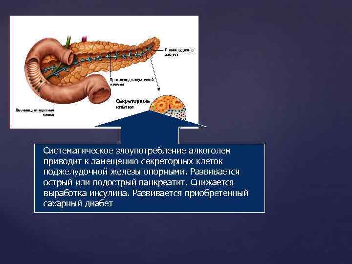 Как влияет поджелудочная железа на печень. Алкоголь поджелудочная железа влияние. Острый панкреатит поджелудочной железы. Гиперсекреция поджелудочной железы. Пищеварительная система поджелудочная железа.