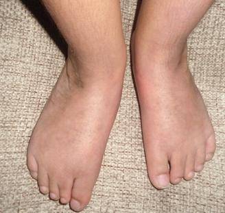 Отечность ног: причины и лечение народными средствами. мочегонные средства при отеках ног