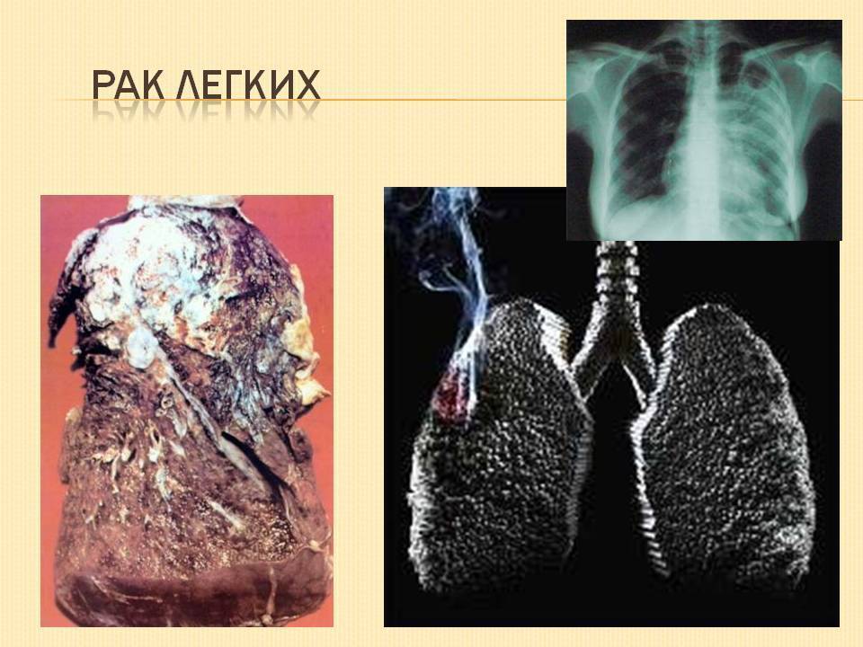 Курение при туберкулезе и его влияние на устойчивость к лекарственным препаратам