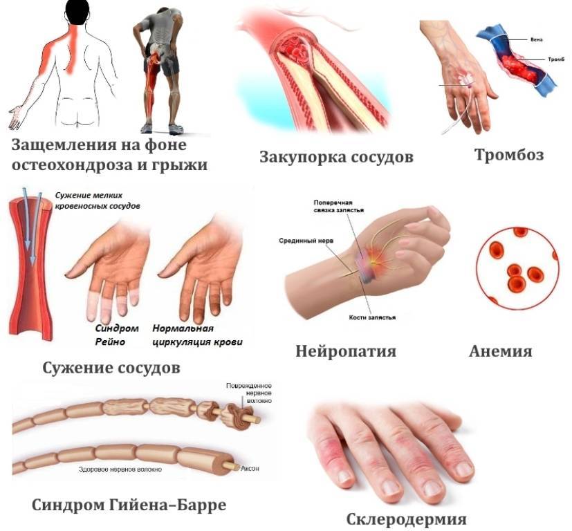 Причины онемения рук по ночам и методы лечения