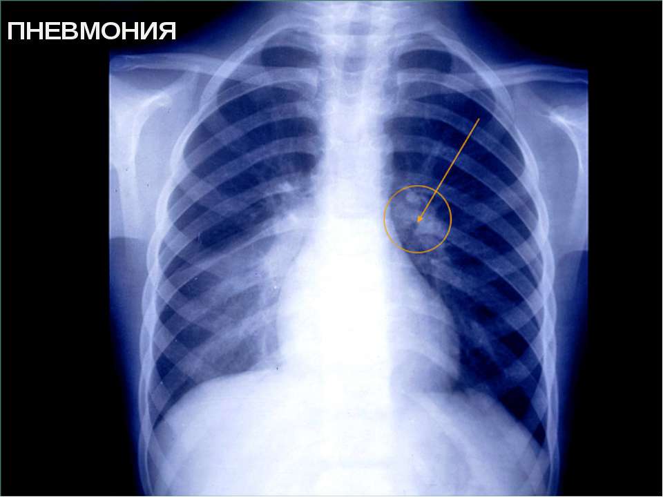 Рентген легких: показания к проведению, оценка вредности и особенности процедуры