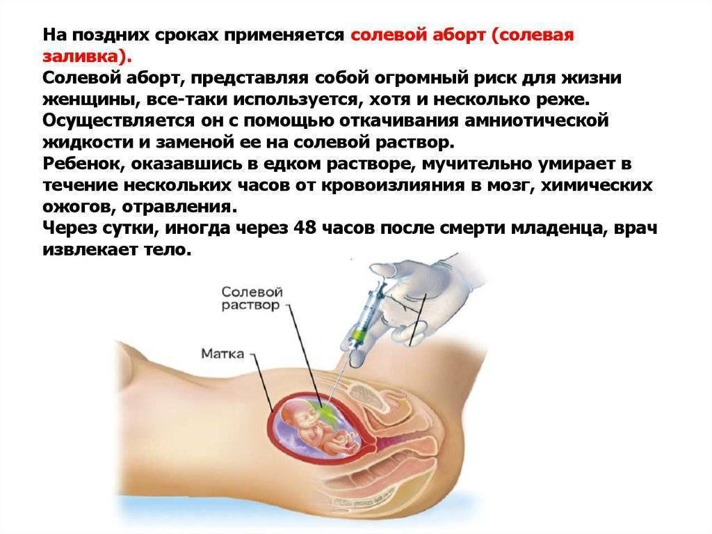 Поздний срок содержание. Половой акт при беременности. Медикаментозное прерывание на позднем сроке. Прерывание беременности на поздних сроках.