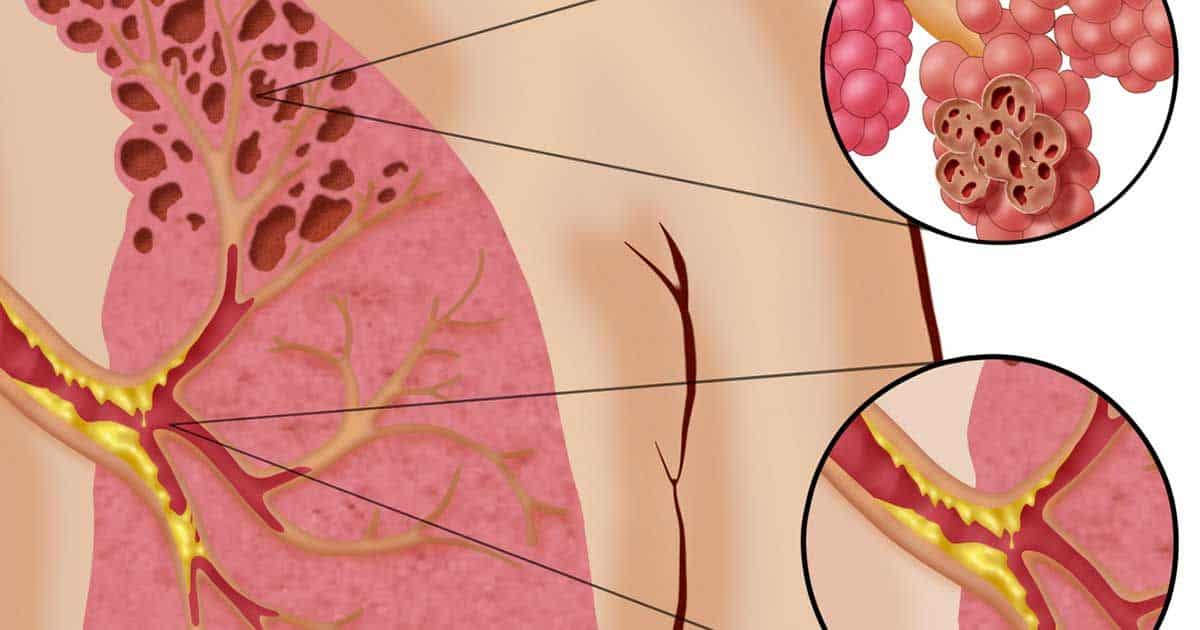 Попкорновая болезнь лёгких: симптомы, признаки, лечение