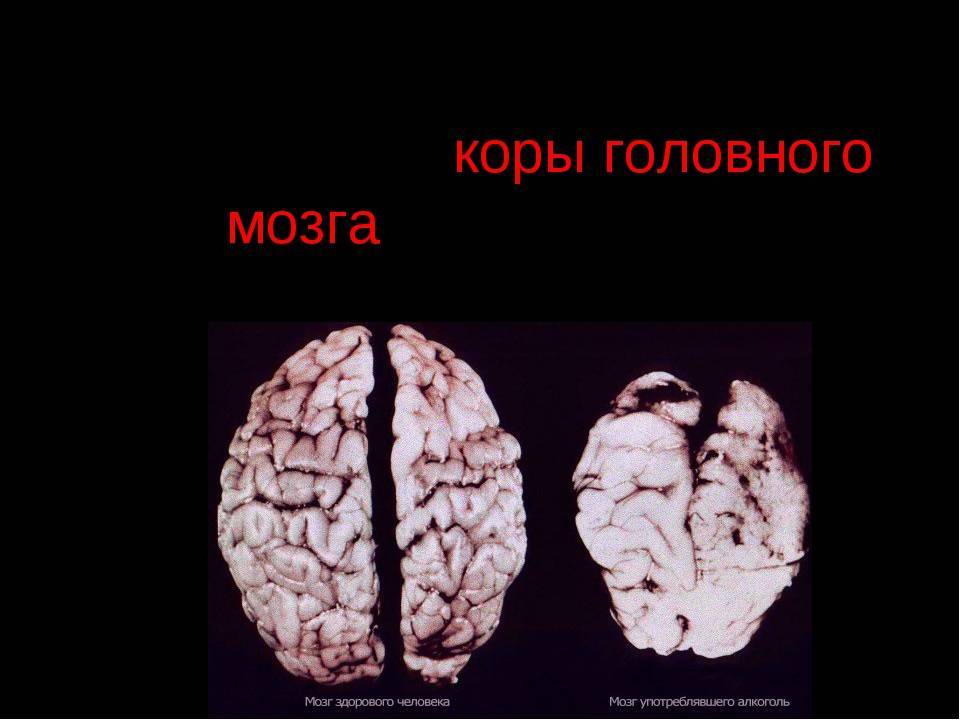 Последствия головного мозга. Головной мозг алкоголика.