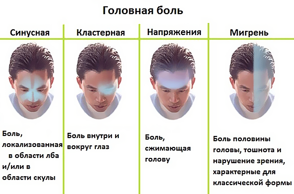 Где болит при мигрени картинка