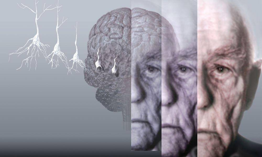 Сенильная дегенерация головного мозга как причина смерти