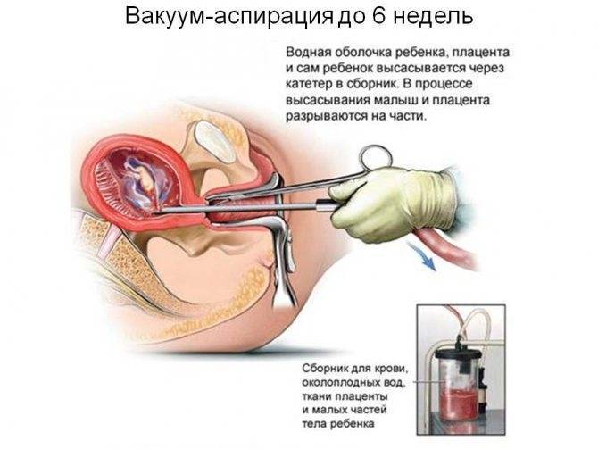 Восстановление после чистки матки: ход периода, длительность