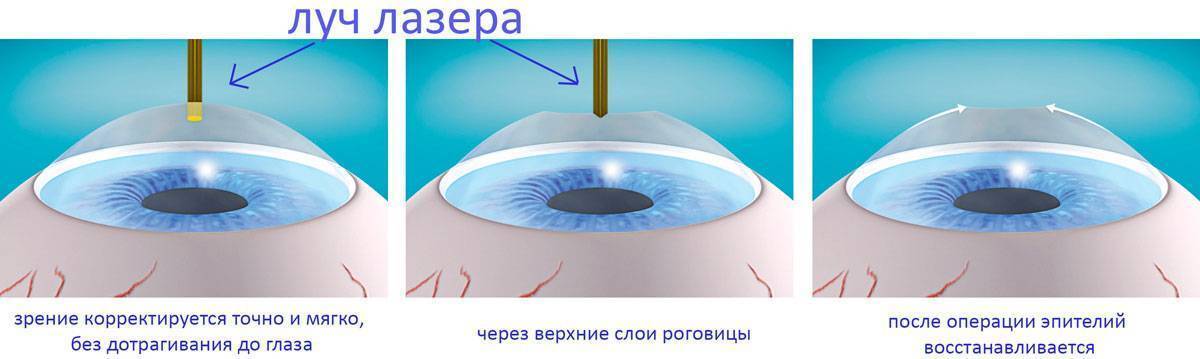 Лазерная коррекция зрения спустя много лет отзывы. Глаза после лазерной коррекции. Роговица лазерная коррекция. Глаза после лазерной коррекции зрения. Лазерная коррекция зрения схема.