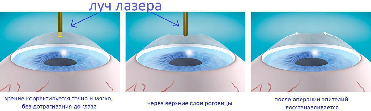 Со скольки лет делают лазерную коррекцию зрения. Зрение после лазерной коррекции. Ограничения после лазерной коррекции зрения. Лазерная коррекция зрения схема.