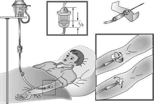 Правильная капельница. Как правильно поставить капельницу. Как правильно ставить капельницу в домашних условиях. Ректальная капельница.